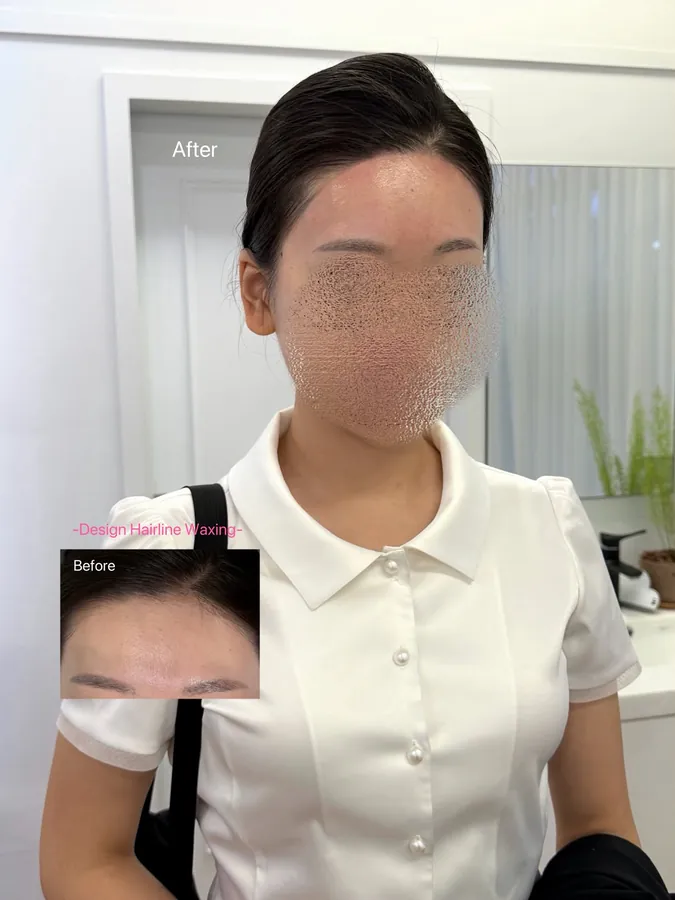 헤어라인 디자인 왁싱 후 모습과 시술 전 작은 사진, 얼굴은 흐리게 처리