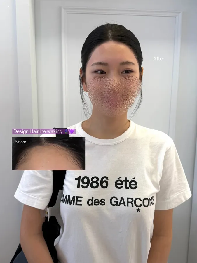 헤어라인 디자인 왁싱 후 모습과 시술 전 작은 사진, 얼굴은 흐리게 처리